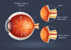glaucoma-1